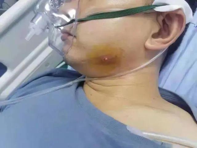 休克、呼吸困难!湖南男子随手挤个痘痘,被送进医院抢救...