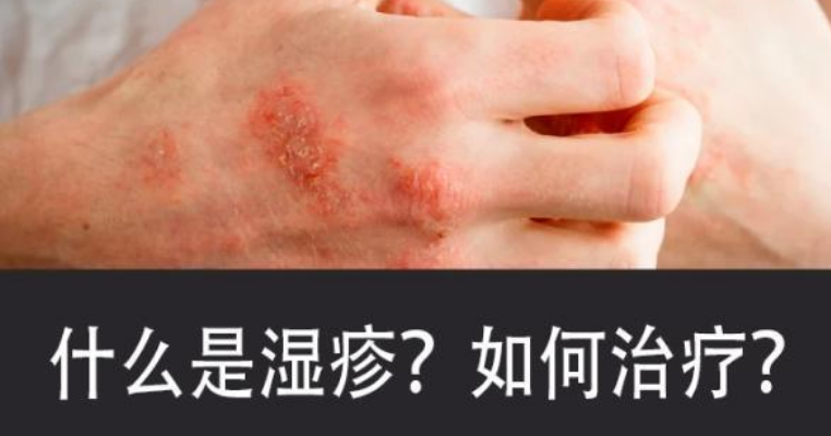 华医皮肤医院：得了湿疹，皮肤瘙痒？