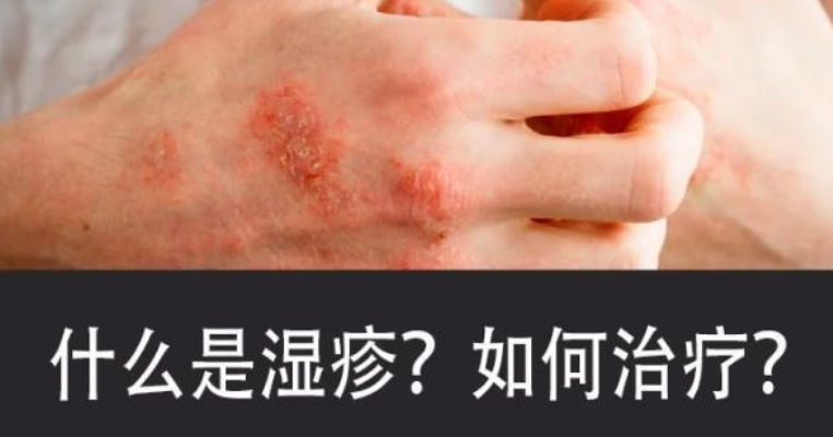 华医皮肤医院:得了湿疹,皮肤瘙痒?